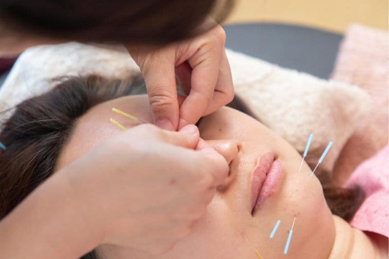 美容鍼で眉間のツボを整える女性の施術風景|安泰漢方鍼灸院