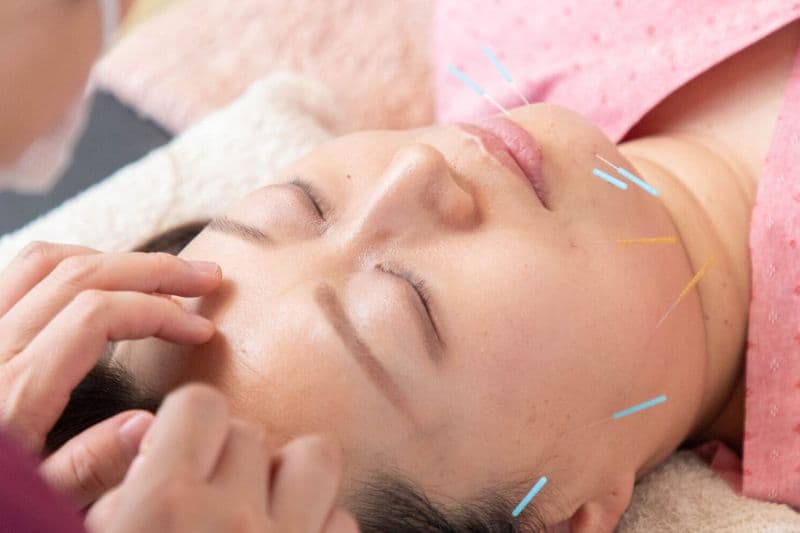 顔全体に鍼を施しリラックスする女性の様子｜安泰漢方鍼灸院