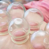 背中にカッピングを行っている様子
